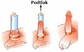 vakuova pumpa s erekcním kroužkem